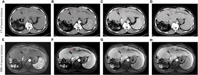 Case report: hepatic arterial infusion chemotherapy combined with sintilimab and lenvatinib for conversion therapy of colorectal cancer liver metastases